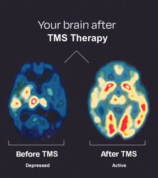 Brain imaging showing the before and after results of TMS therapy. West Chester, PA residents can simply call to book a session to start treatment for depression, anxiety, OCD and more.